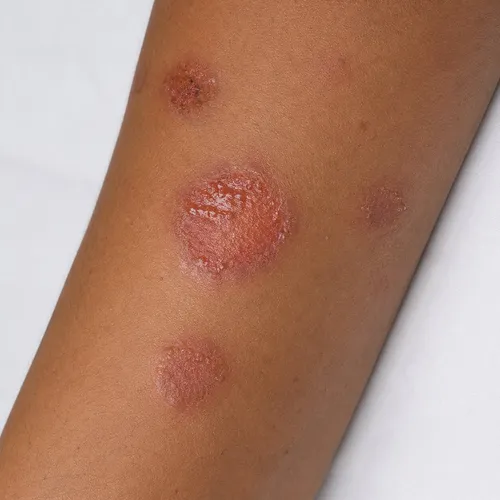 Eczema and dry inflamed skin treatment