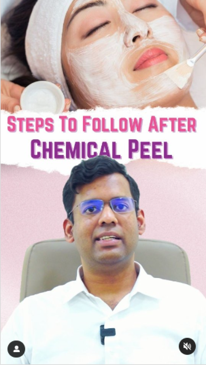 Steps to follow after chemical peel