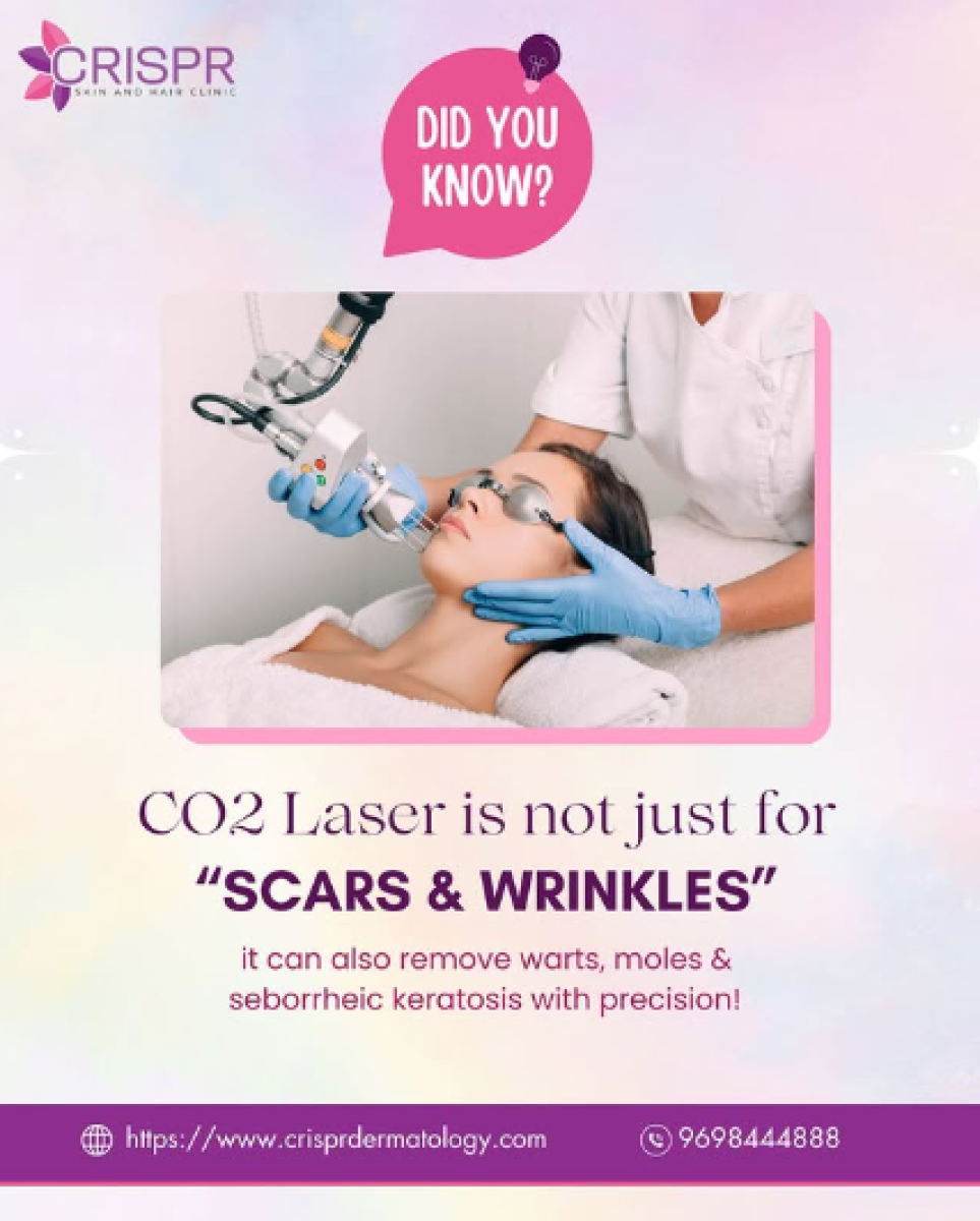 CO2 Laser – More Than Just Anti-Aging!