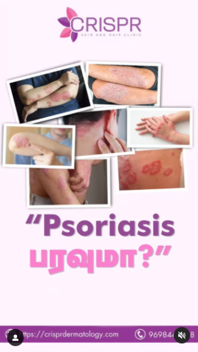 Does Psoriasis Spread?