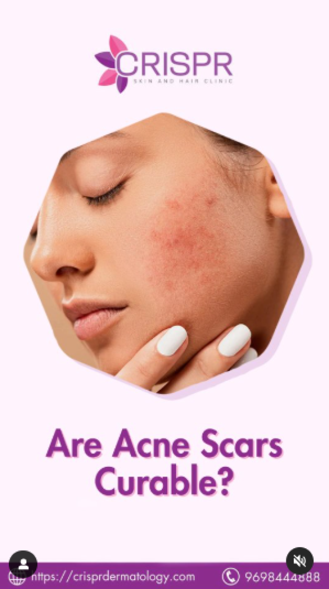 Are Acne Scars Curable?