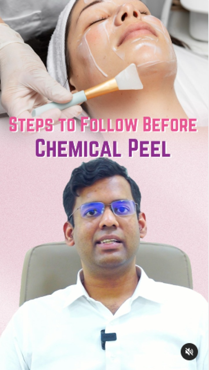 Steps to follow before the chemical peel