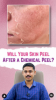 The Truth About Peeling After a Chemical Peel!